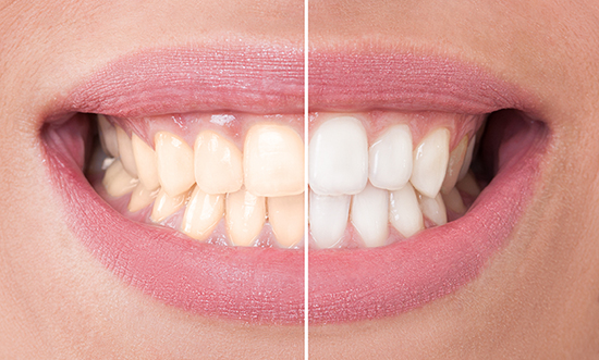 Teeth Whitening - Waco, TX - Cosmetic Dentistry