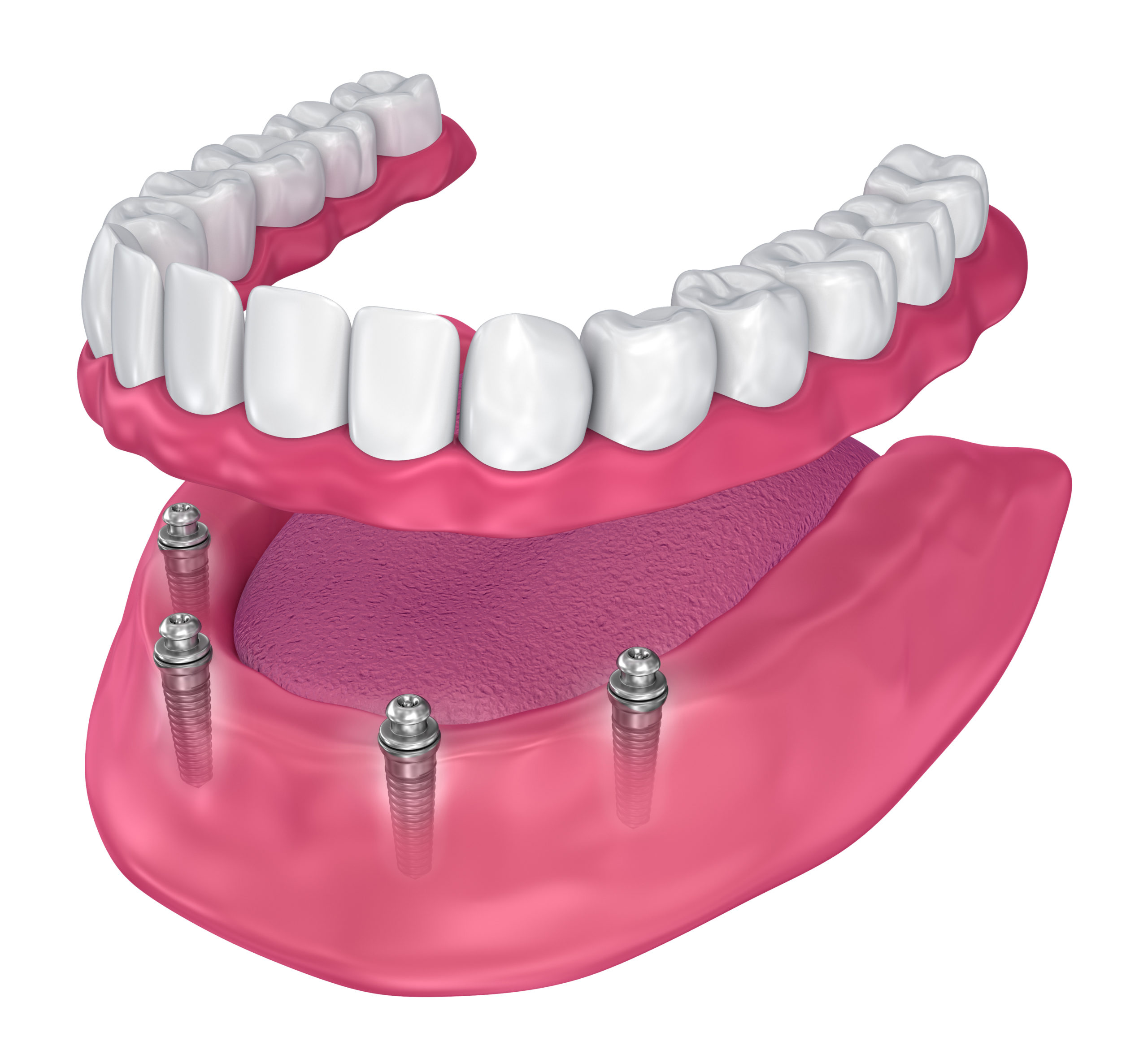 Dental Implants and Dentures – Better Together