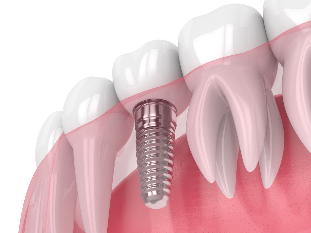 Will I Need General Anesthesia for My Dental Implants