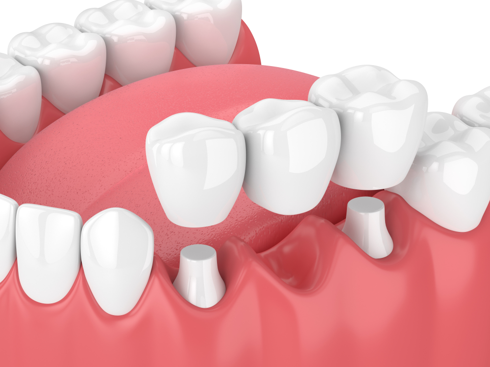 Dental Bridges: Affordable and Painless