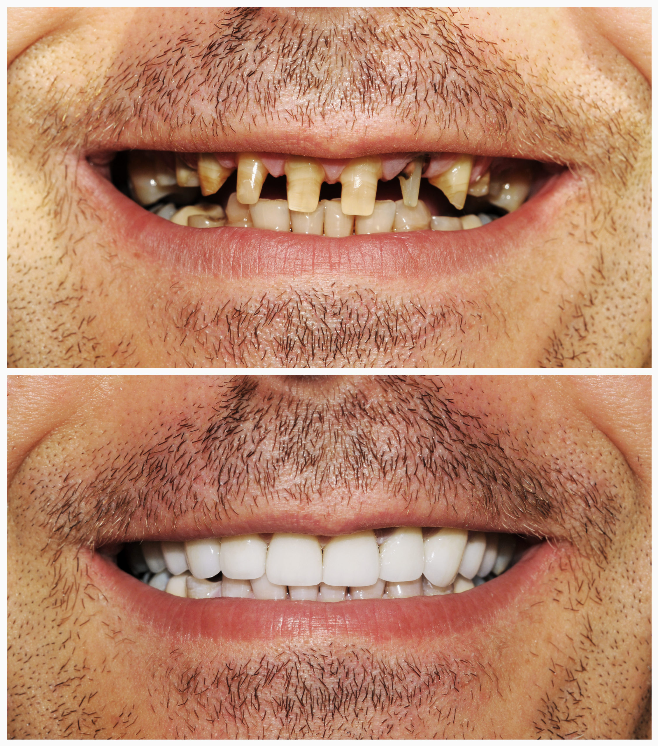 What Is a Full Mouth Reconstruction?