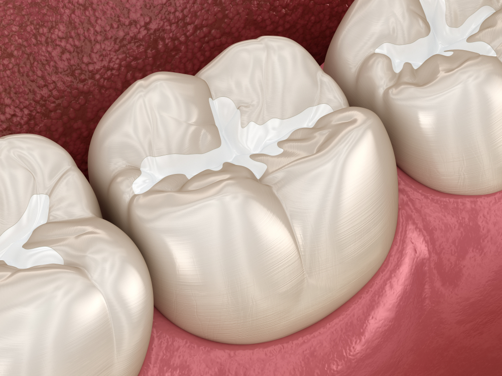 What is Dental Sealant?