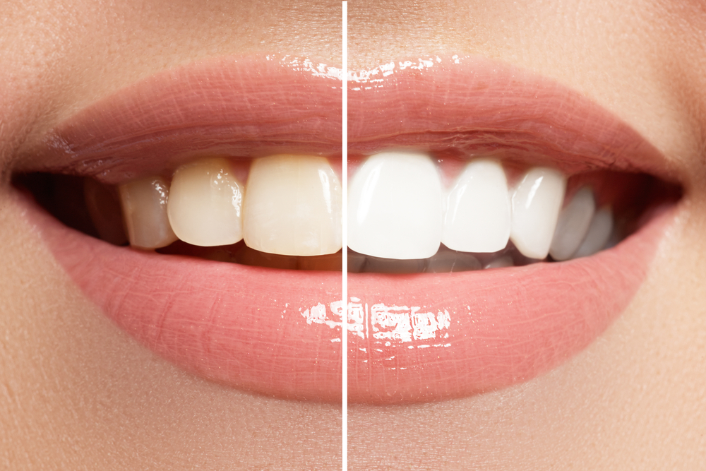 Treat Your Valentine And Yourself To Whiter Teeth