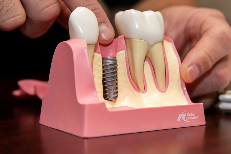 How to Maintain Your Dental Implants