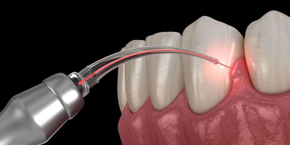 LANAP: The Minimally Invasive Laser Gum Disease Treatment