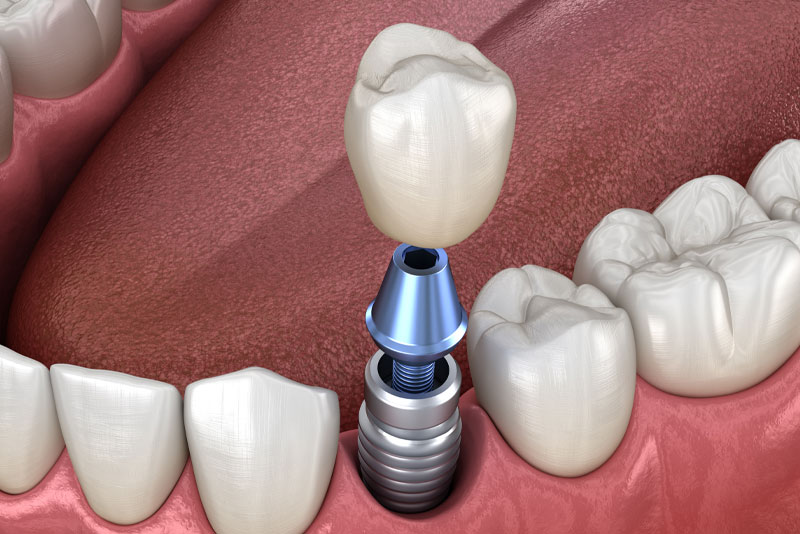 Steps to Properly Care for Your Dental Implants