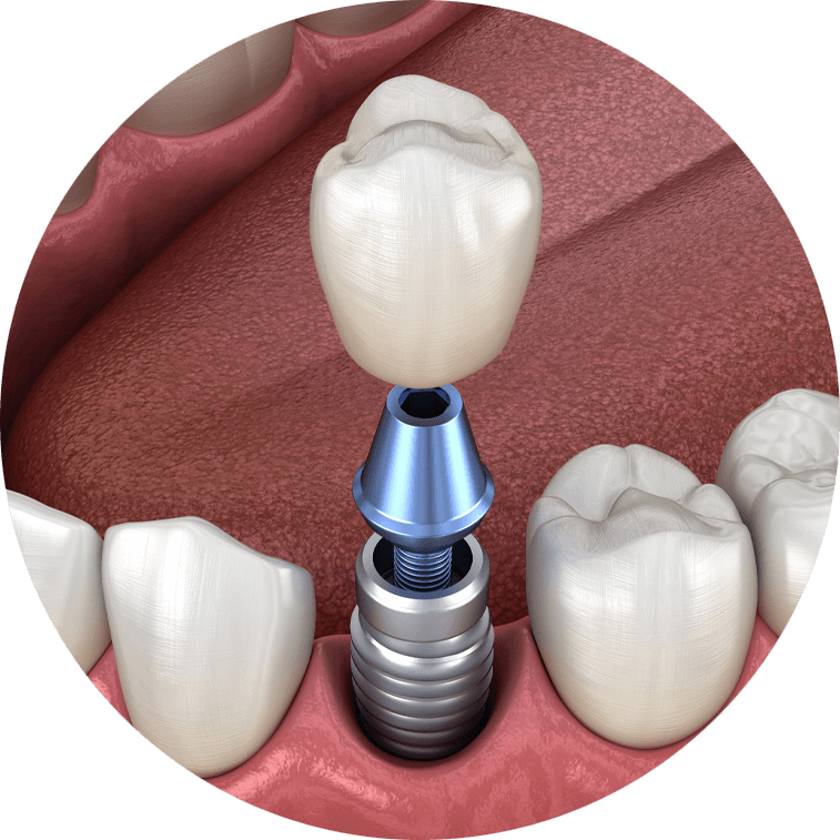 dental implant model.