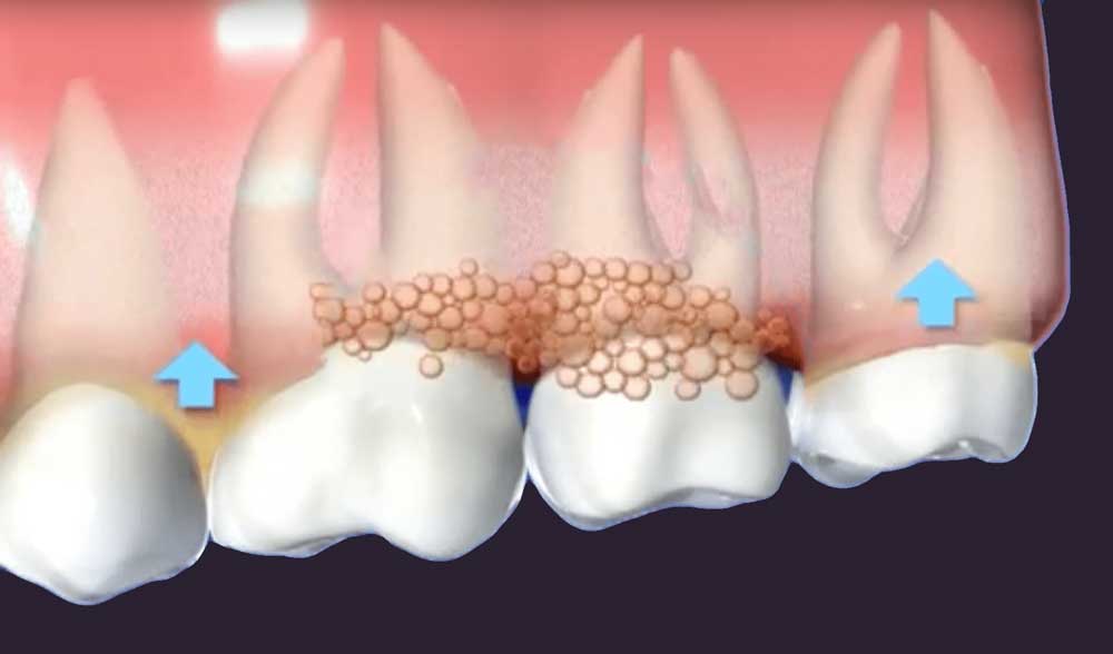 Importance of Treating Gum Disease