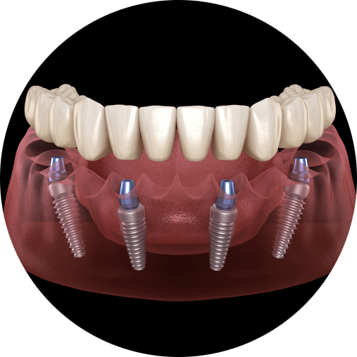 Can Teeth-in-a-Day™ In Waco, TX Benefit Me?