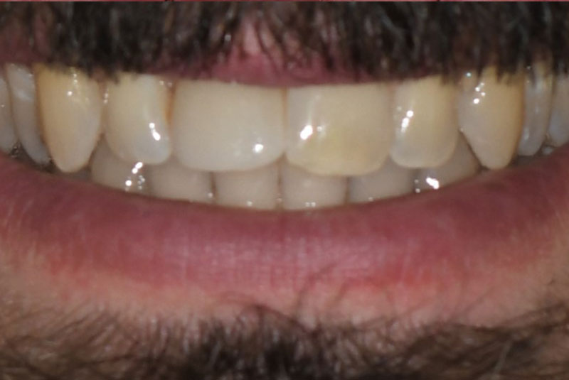 dental implant patient