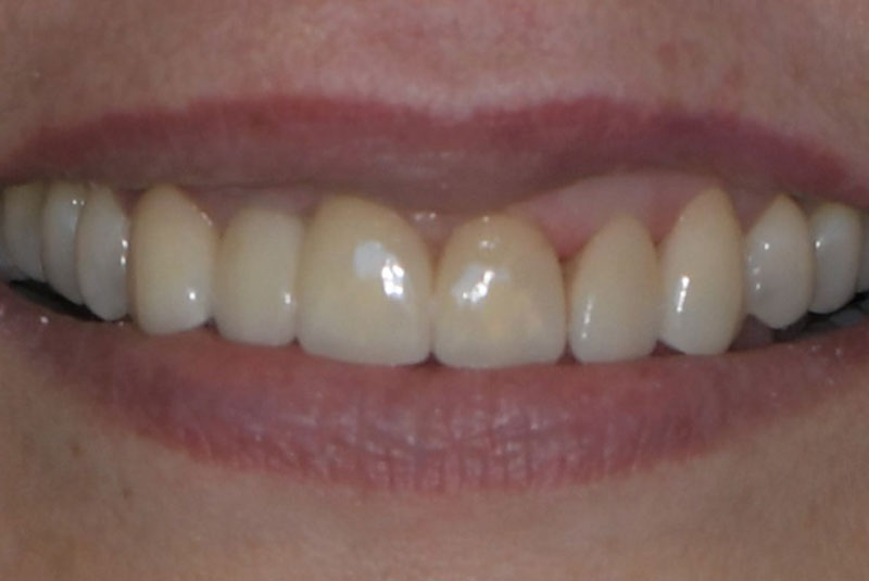 Dental patient after veneers