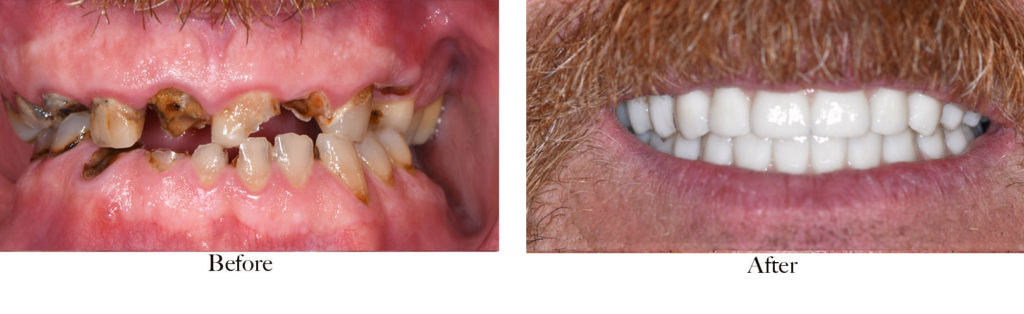 before and after full mouth reconstruction