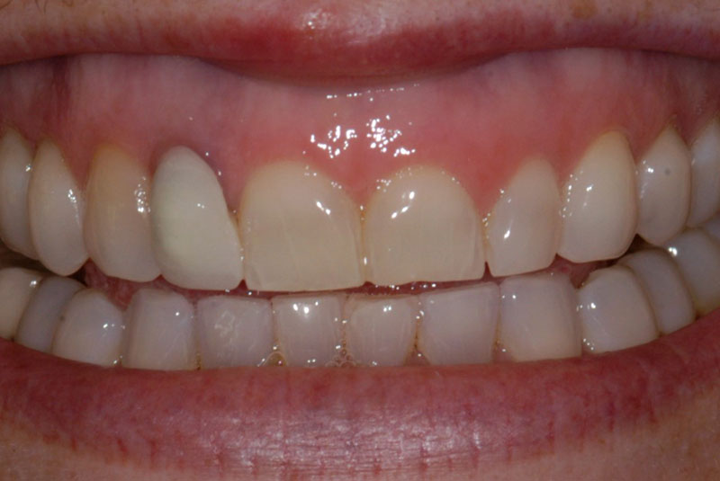 Dental Patient Before Veneers