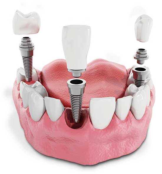 model of multiple dental implants being placed