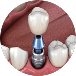 the three different components which make a dental implant