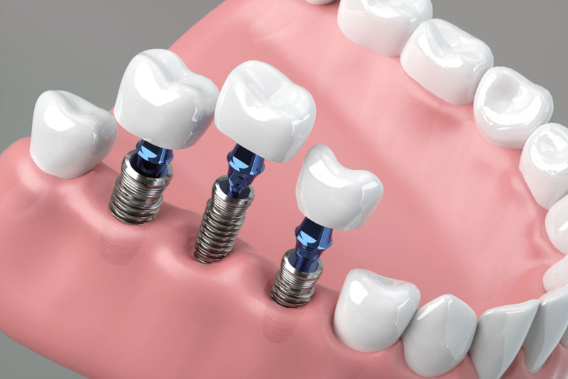 three single dental implants being placed into a jaw model.