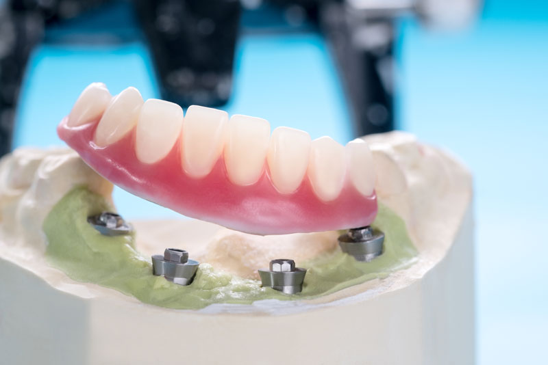 an implant supported denture model all on four implant posts.