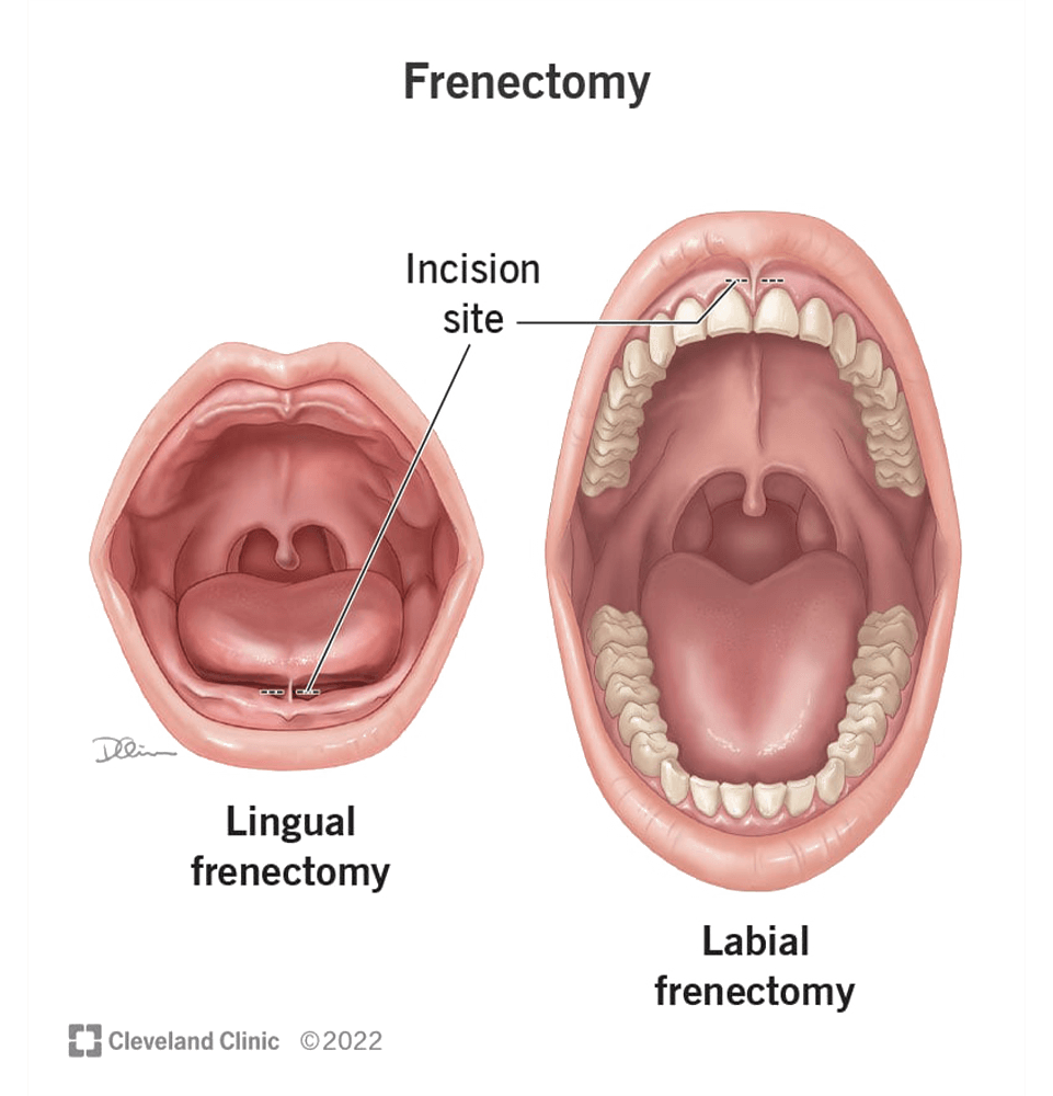 Frenectomy Tongue Tie Waco, TX Creekwood Dental Arts