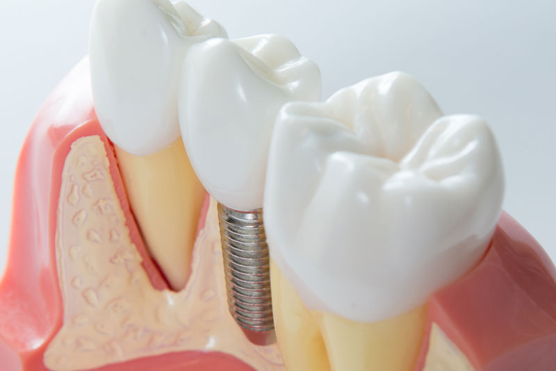 a digital model of a dental implant post and crown.