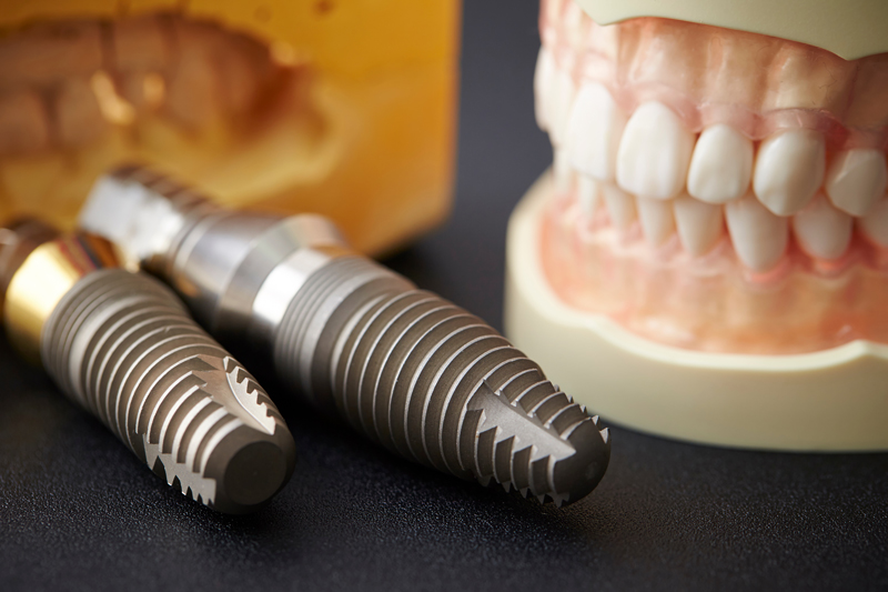 Photo of implant and tooth model