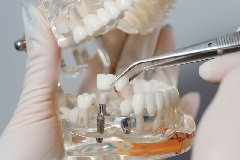 Female smiling with a diagram showing where her dental implant is at; blue background