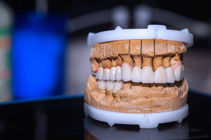 Does Anything Happen If I Don’t Replace My Missing Teeth With Dental Implants In Waco, TX?