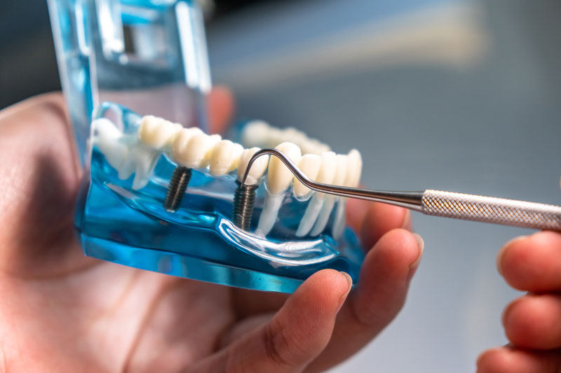 Conquering the Unknown: Understanding the Dental Procedure of Implants