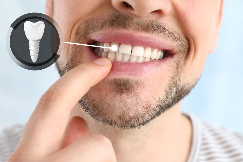 The Strength in your Smile: Understanding the Role of the Tooth Post in Dental Implants