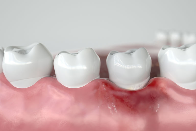 inflamed gums around a tooth, 3d image, grey background