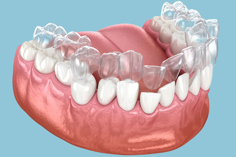 Achieve a Perfect Smile with ClearCorrect in Waco, TX: A Comprehensive Guide |